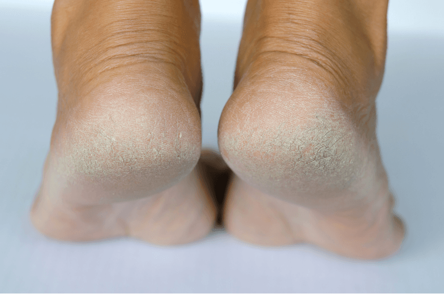 Close-up of dry cracked heels — ArniCura helps soothe and moisturize